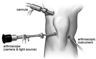 Arthroscope