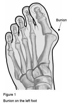 Bunion