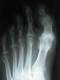 Foot Xray