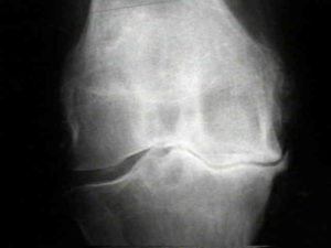 Osteoarthritis